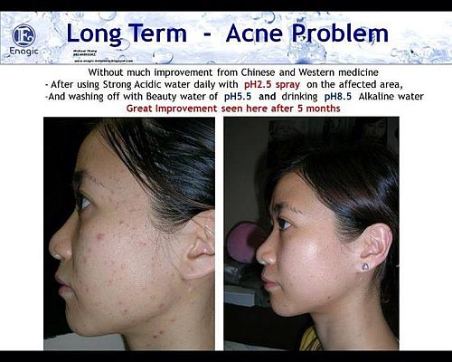 Long Term Acne